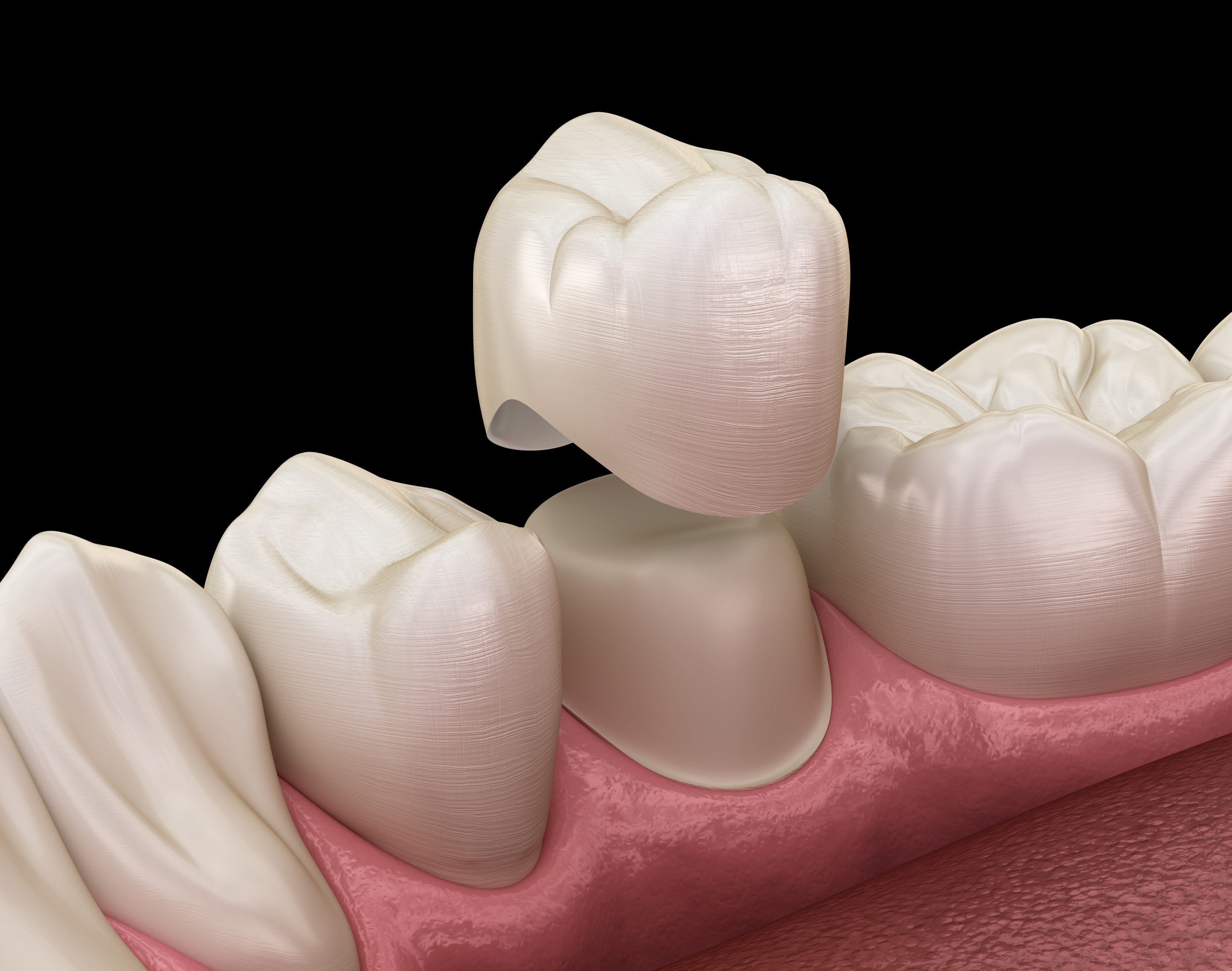 Dental crown premolar tooth assembly process. Medically accurate 3D illustration
