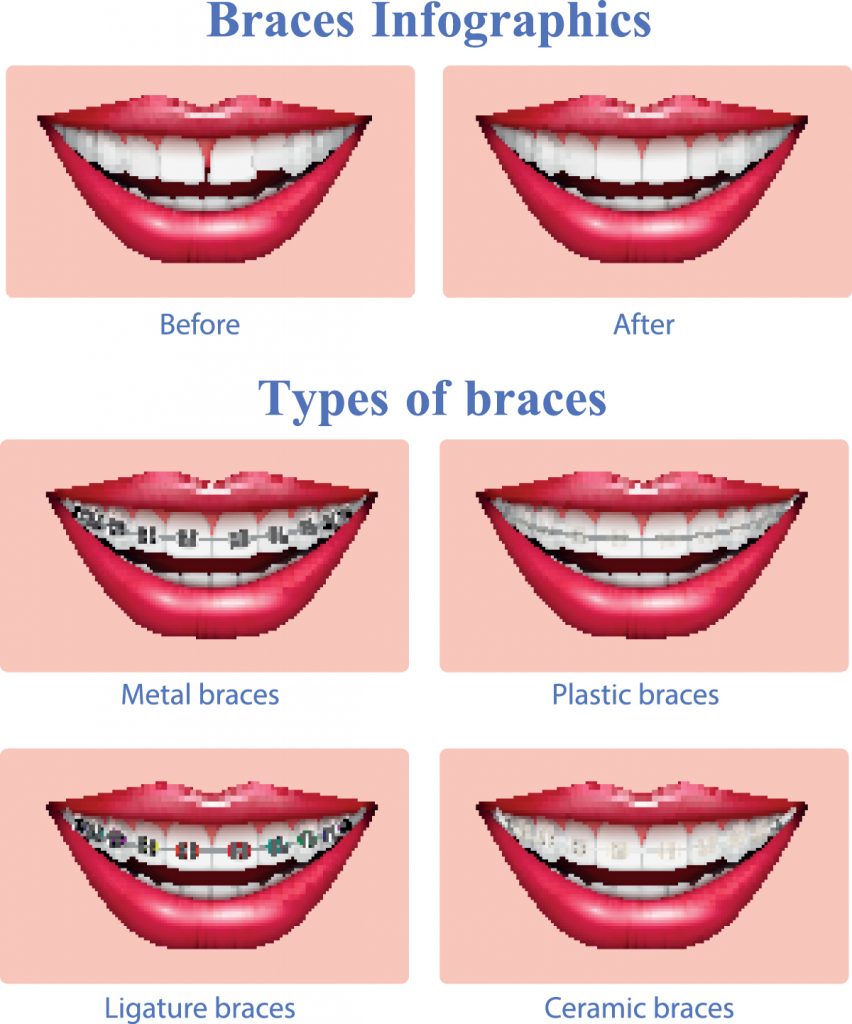 About Types of Braces