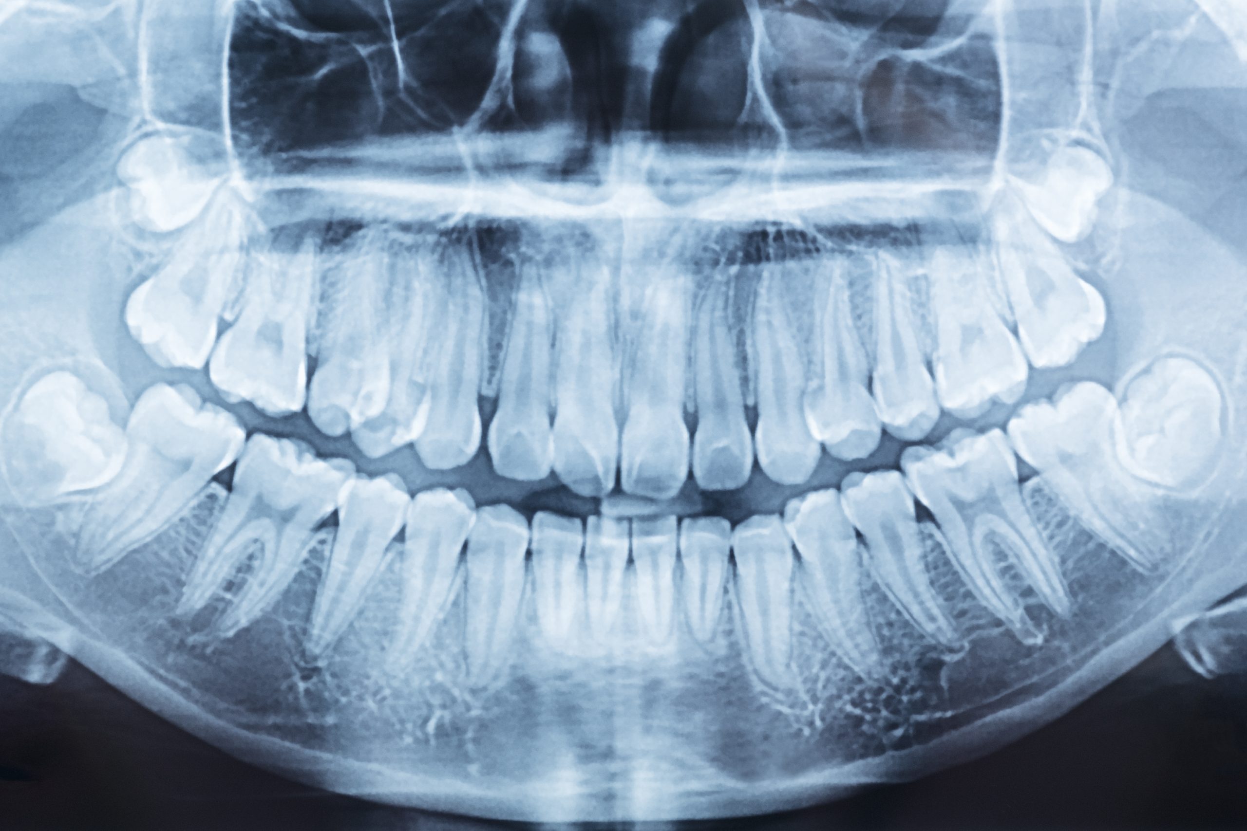 film x-ray of a mouth