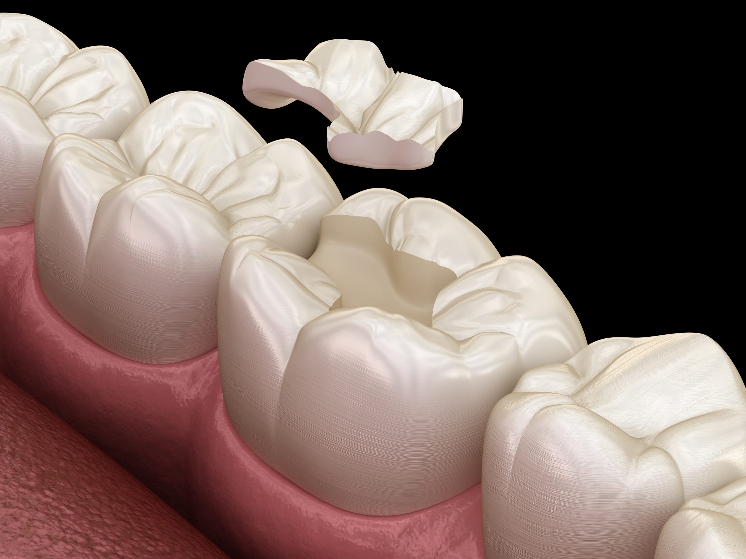 Inlay ceramic crown fixation over toot