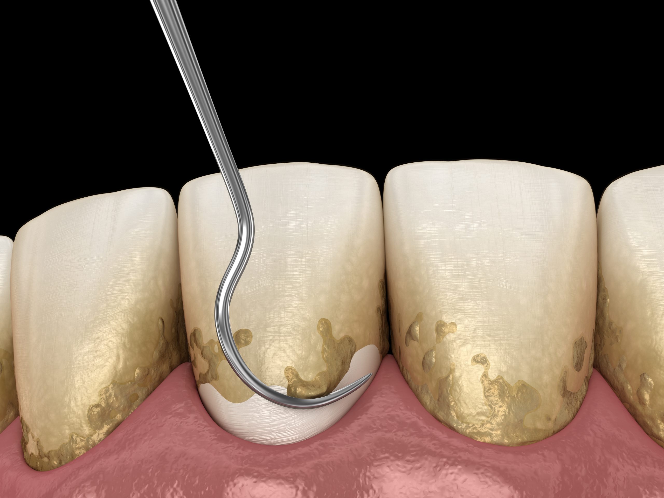 Phases of Periodontal Therapy in Coconut Grove