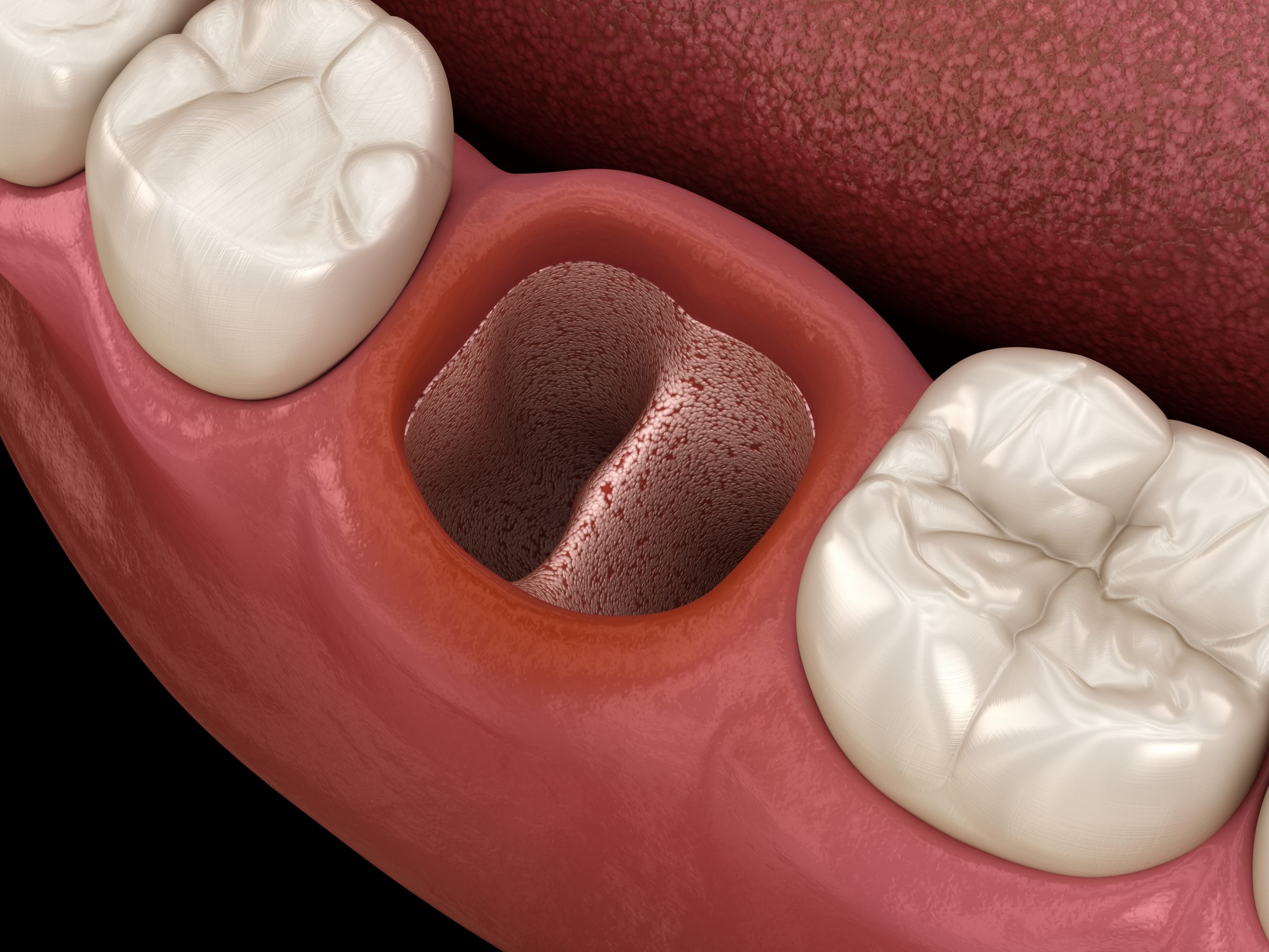 Alveolits - opened dry soket