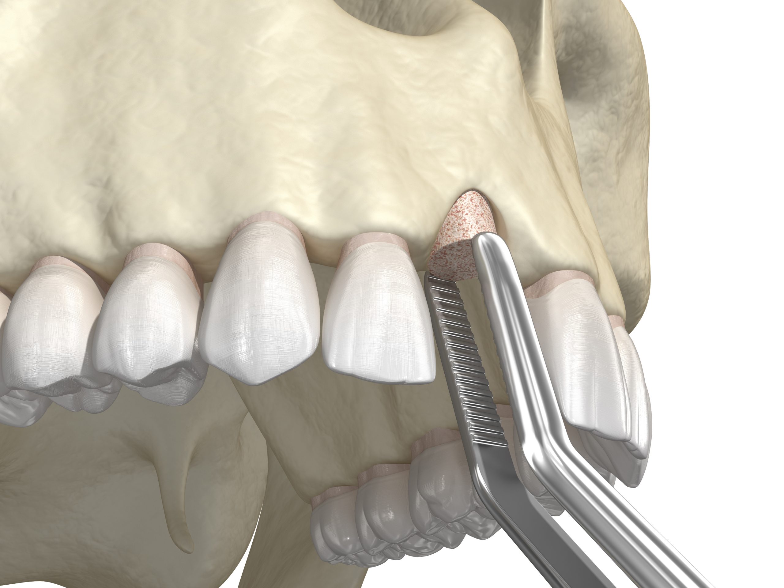 Bone grafting