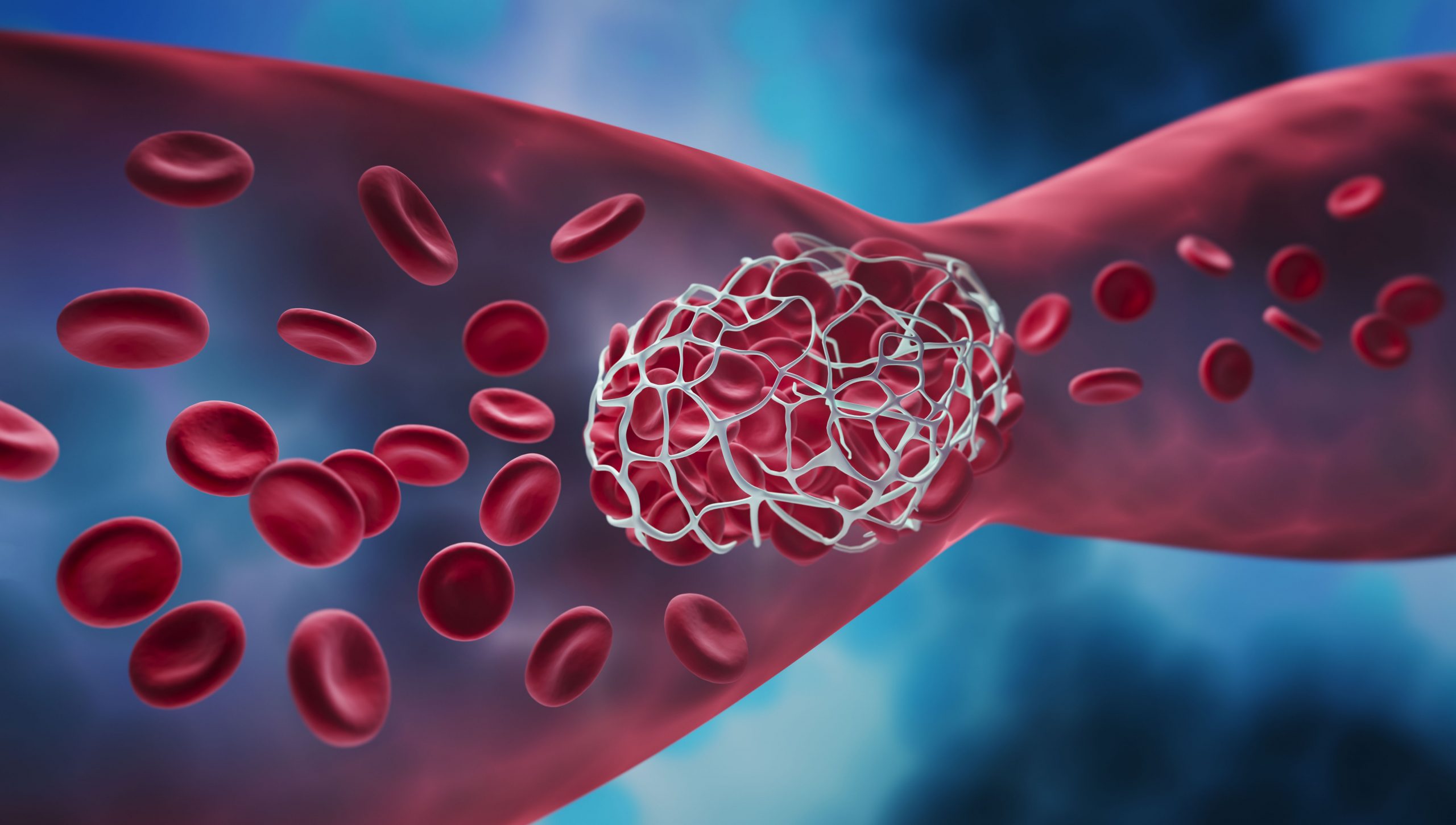 Blood clot blocking a blood vessel