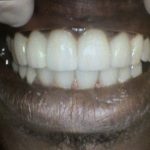 Damaged crowns and broken teeth AFTER
