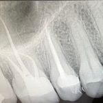 Root Canal in Miami
