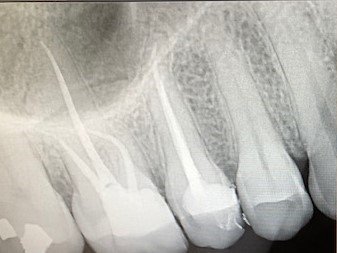 Root Canal in Miami