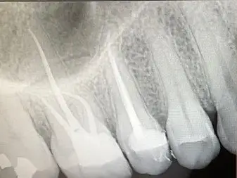 Root Canal in Miami