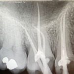 Root Canal in Coral Gables