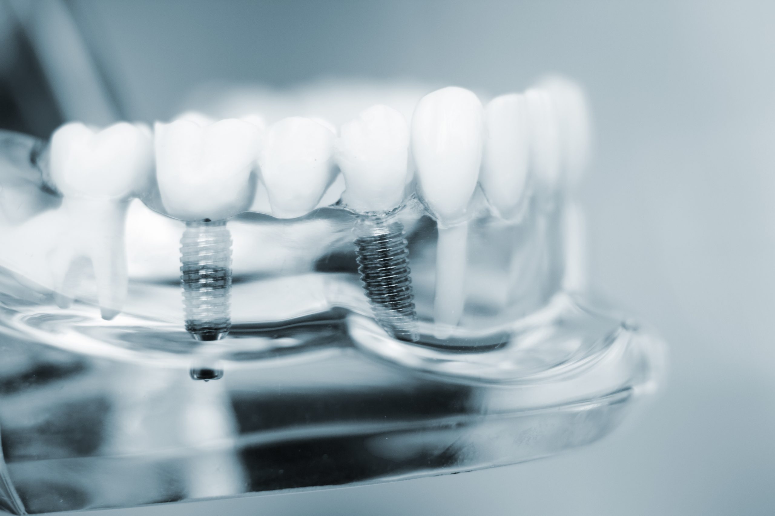 Dental Implants in Coconut Grove