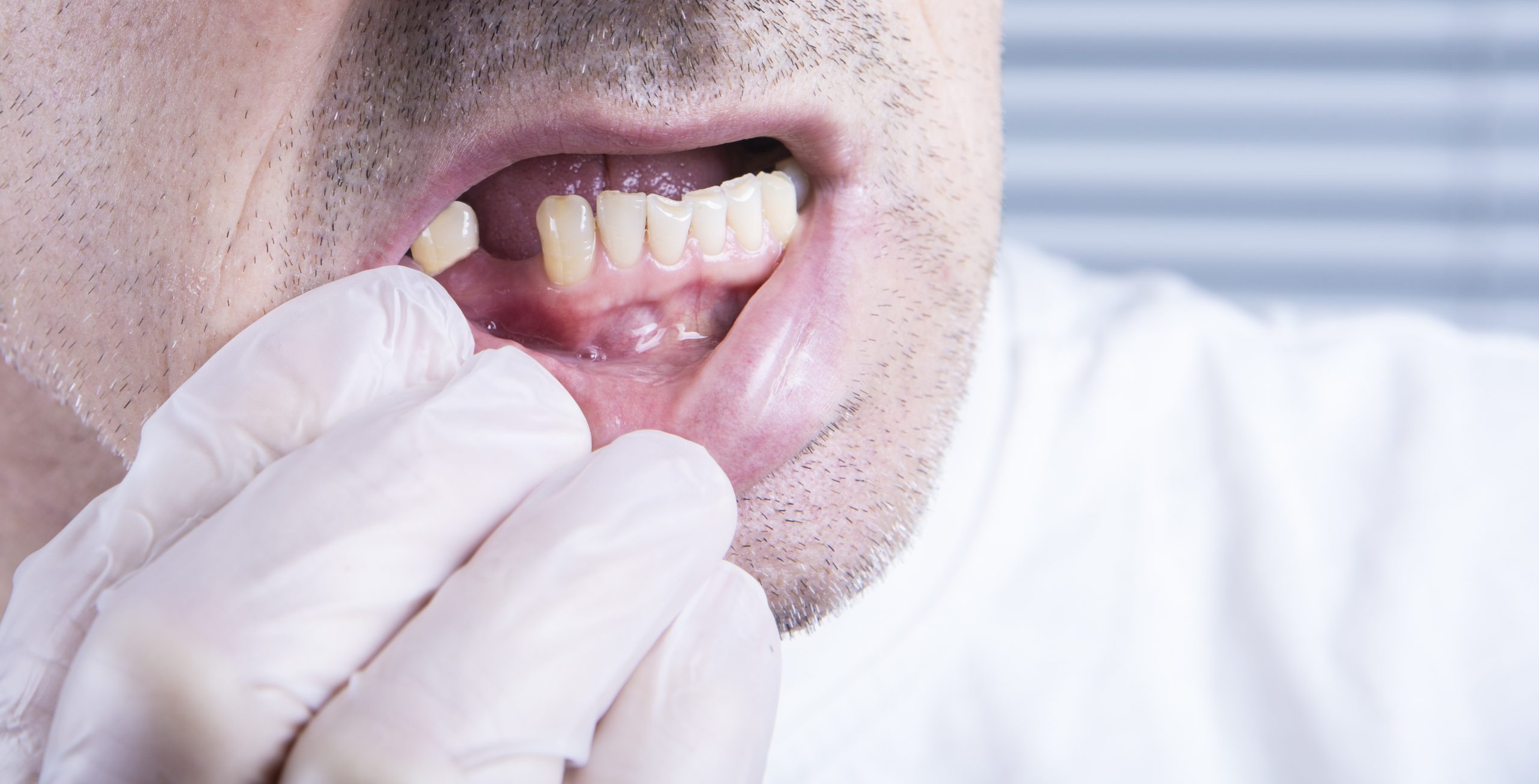 Hidden Consequences of Losing Teeth