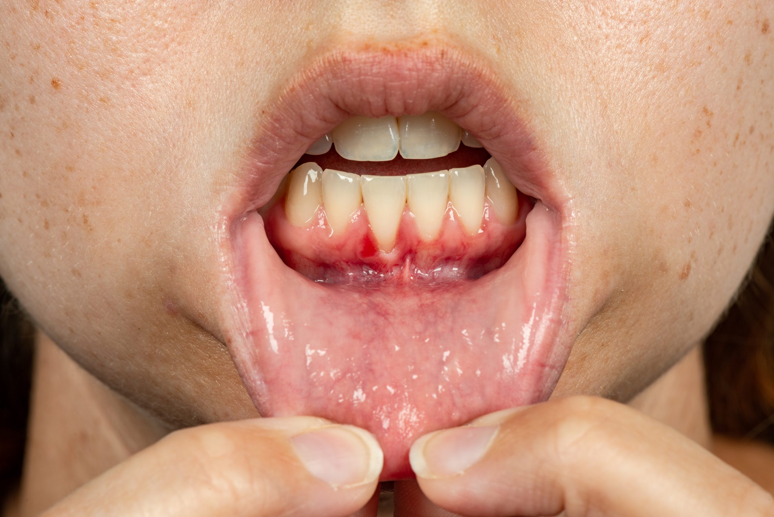 Close up of gum recession