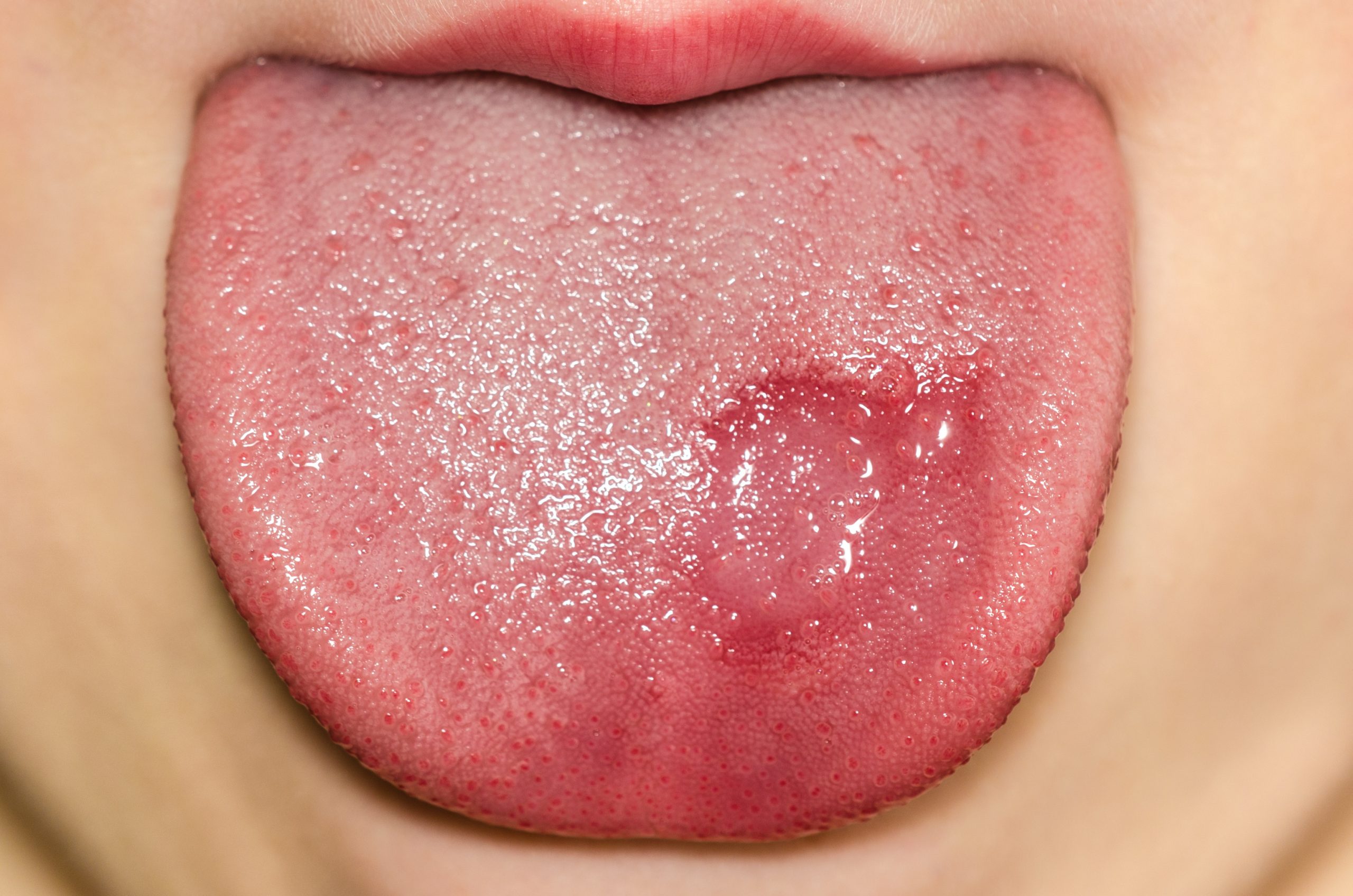 Geographic tongue disease on a caucasian child