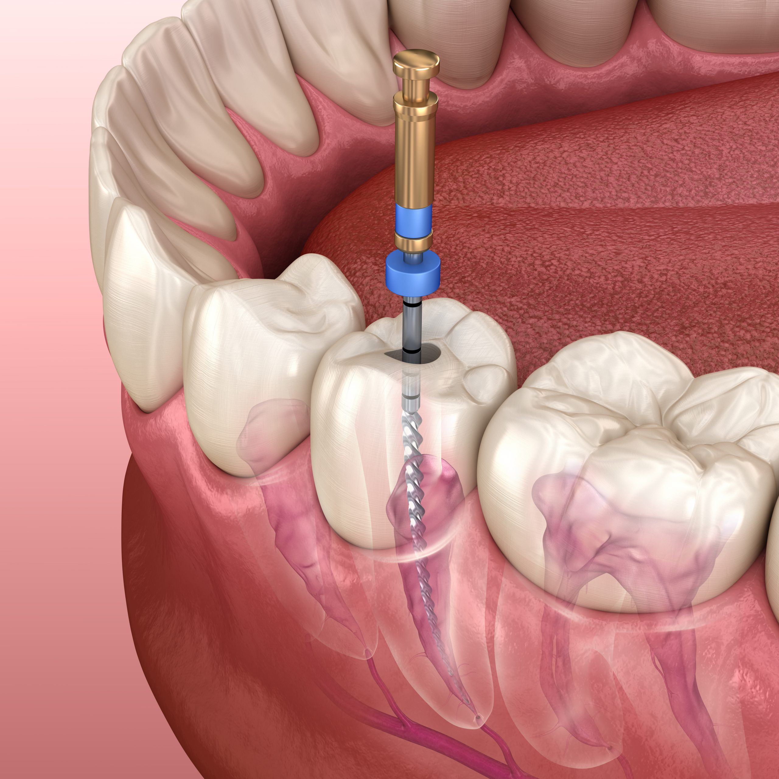 Endodontic root canal treatment