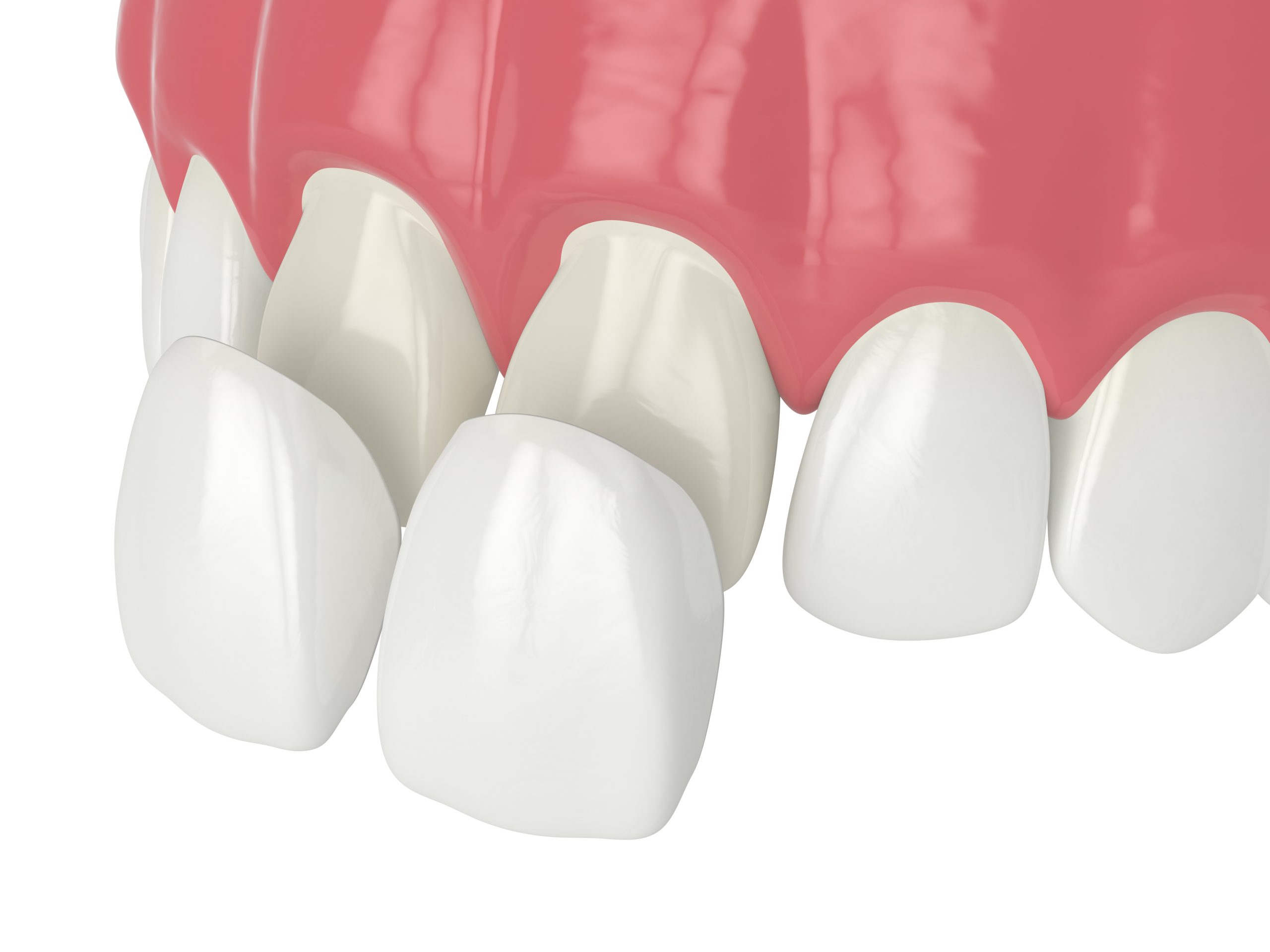 Does a Dental Veneer Treatment Damage Teeth? - Gables Exceptional