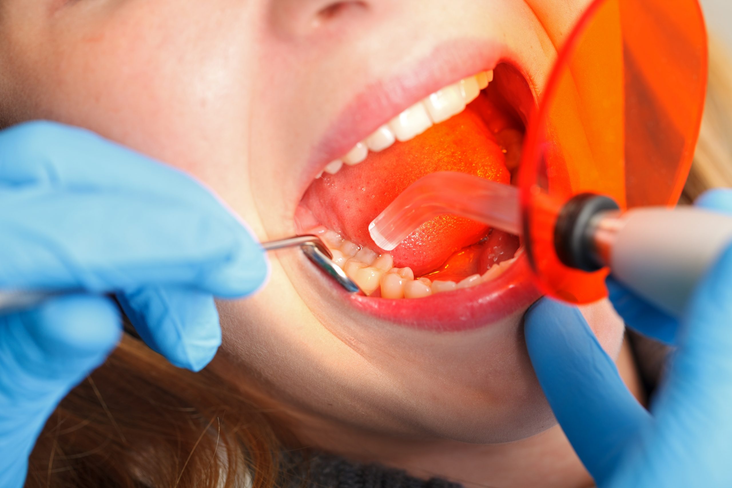 Dental obturation