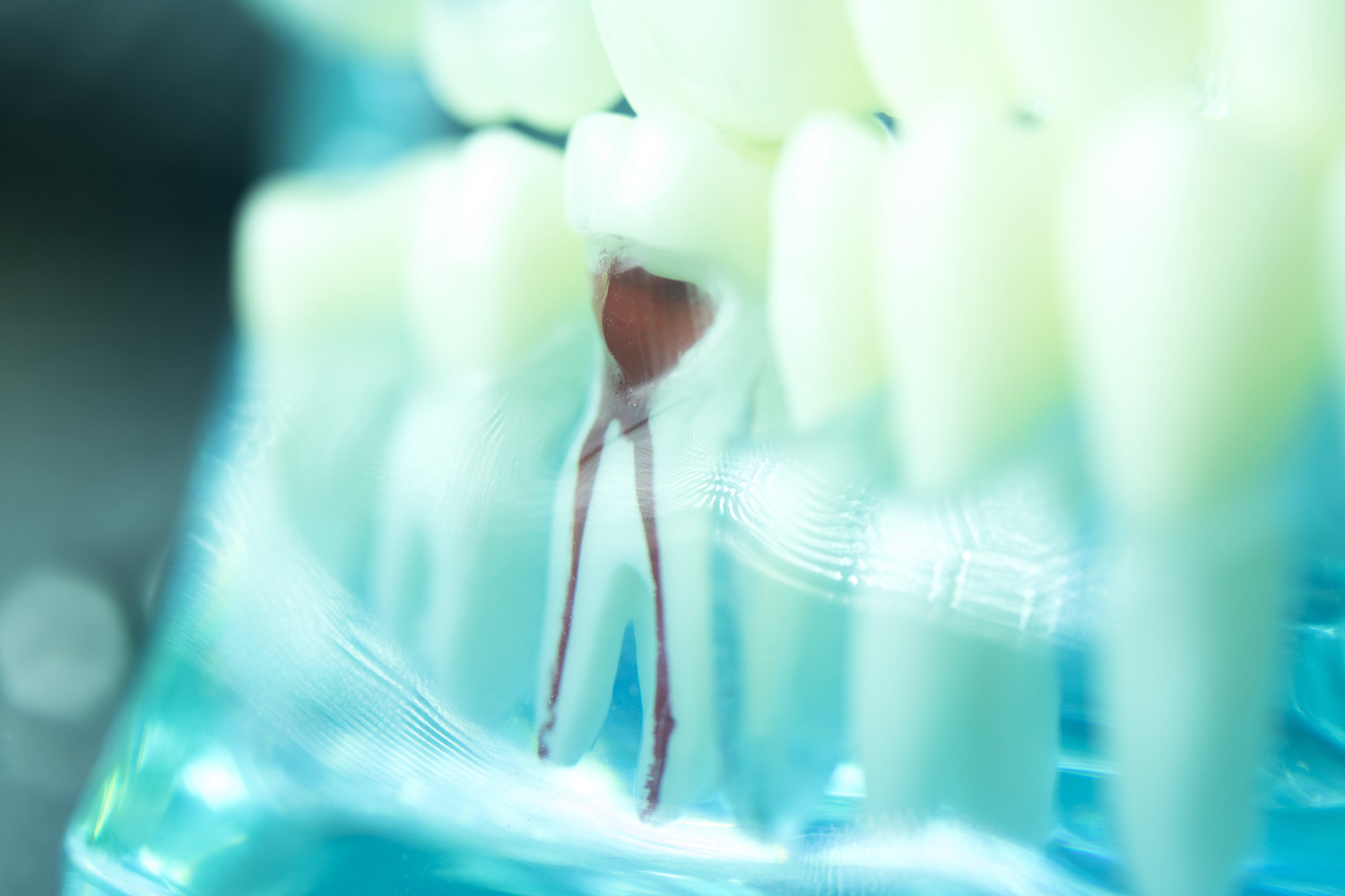 Root Canal Treatment Miami