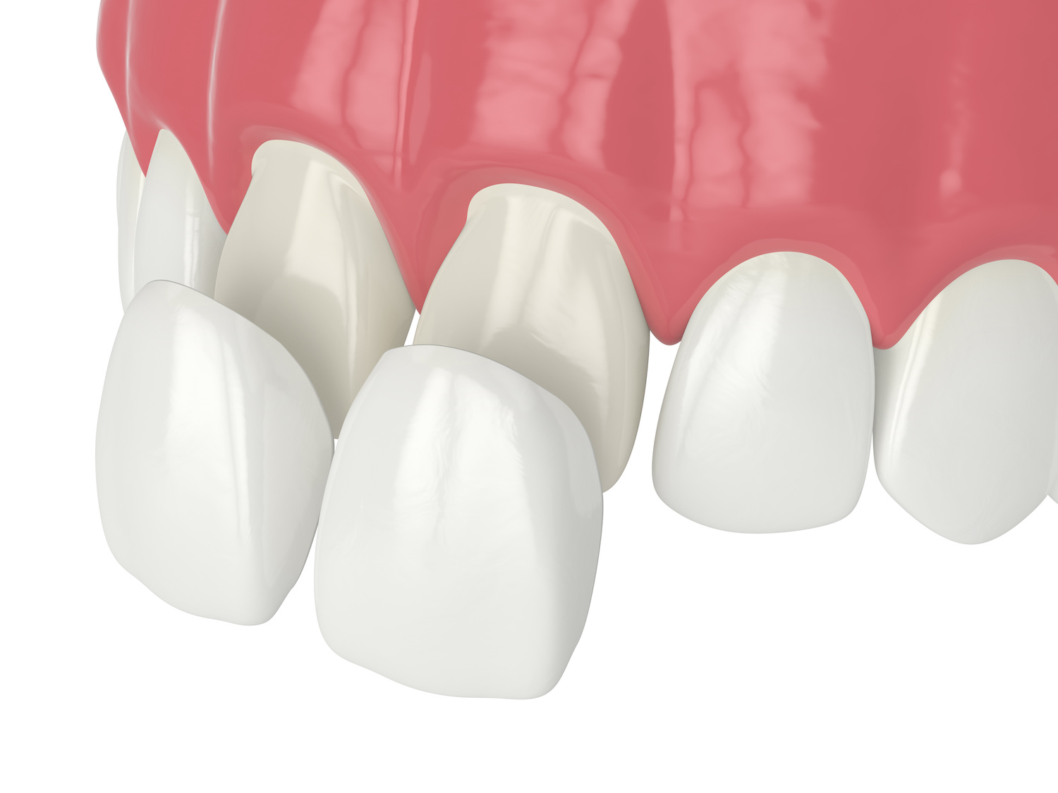 How Much Are Dental Veneers in Miami