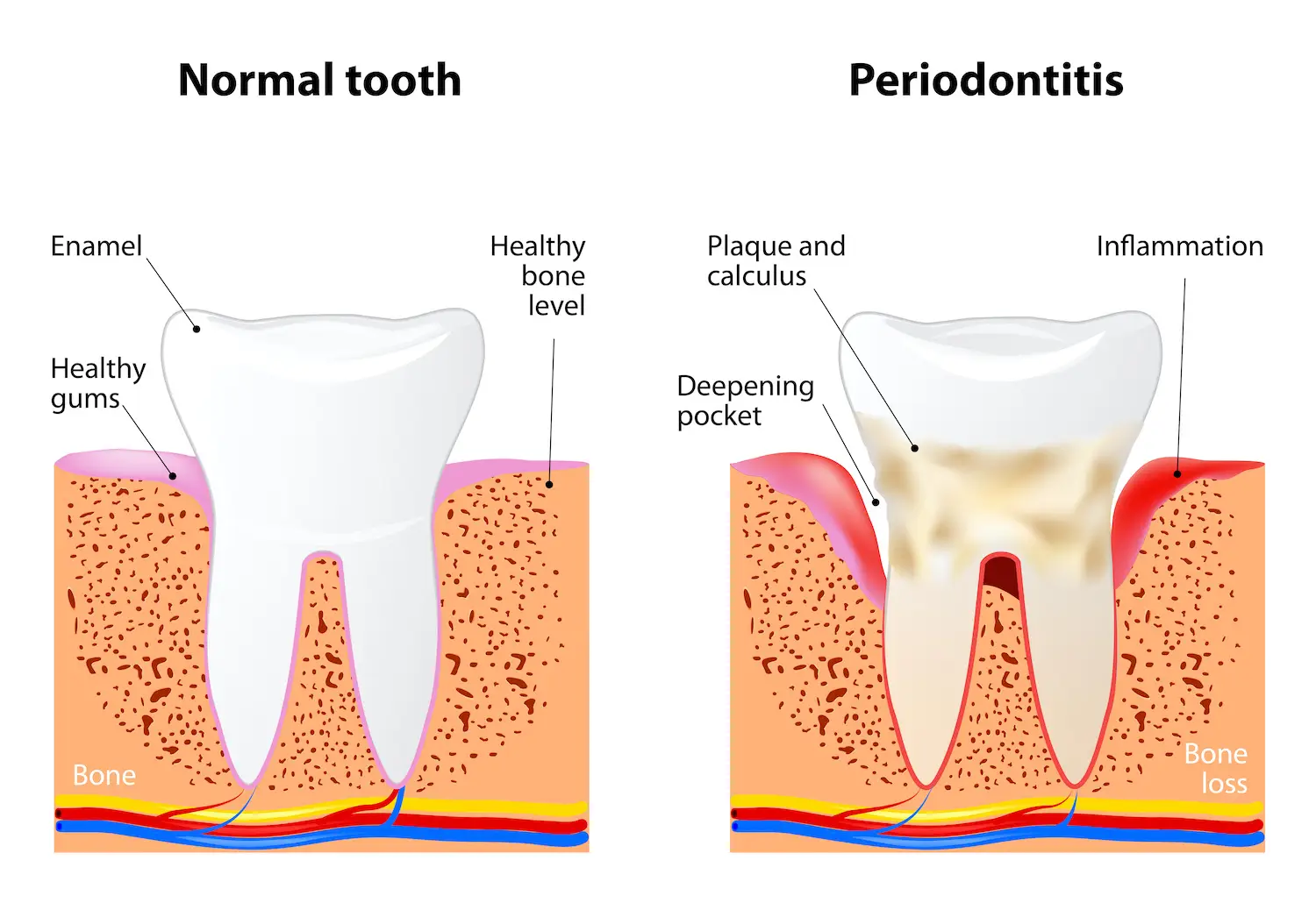 Periodontal Disease Treatment in Kendall