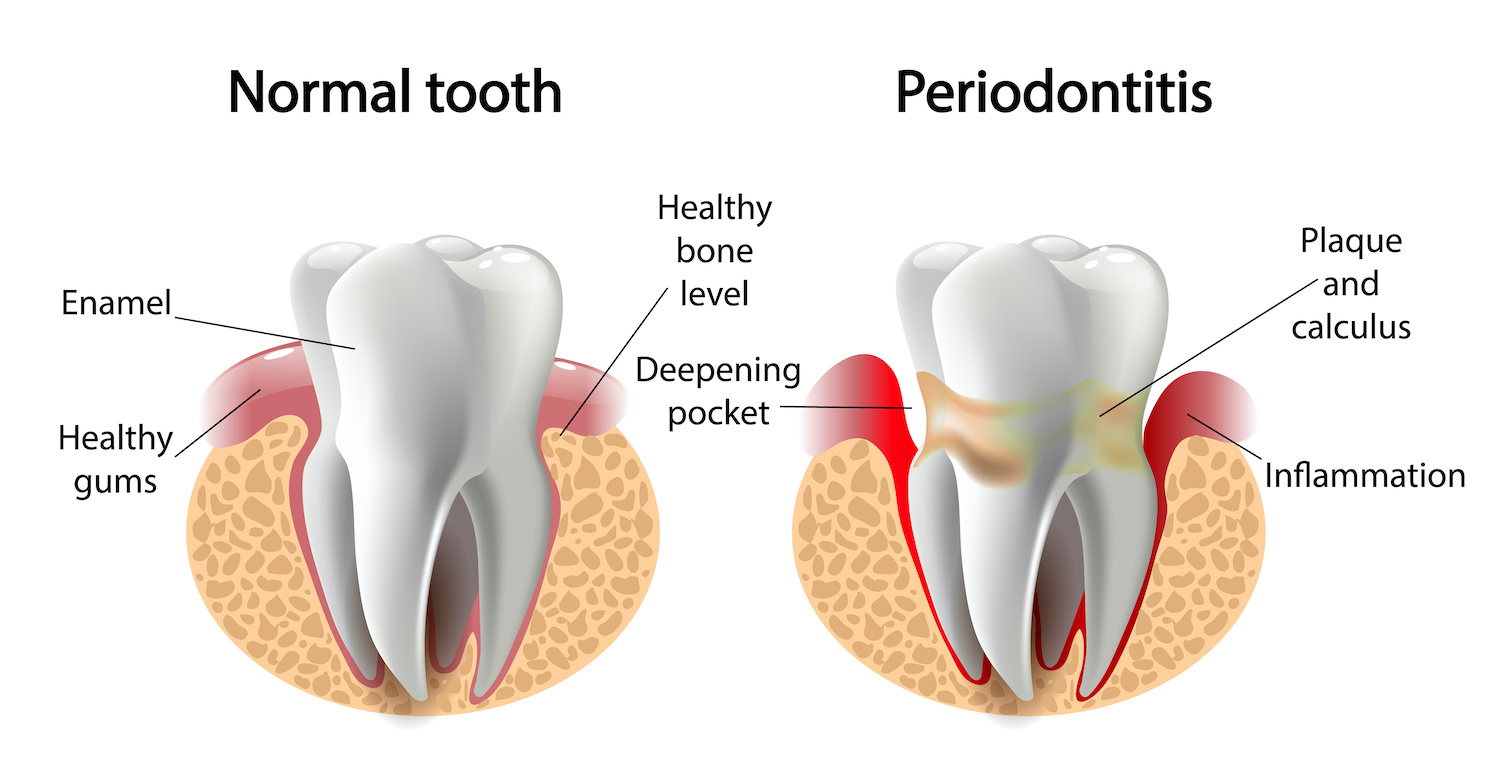 Awareness Gum Disease