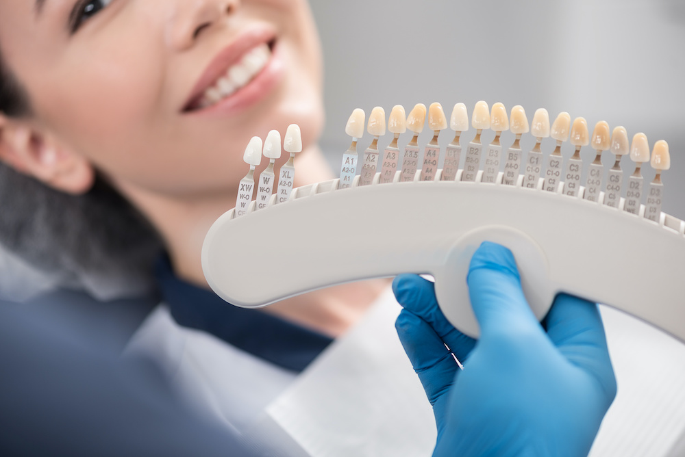How Much Are Dental Veneers in Miami?