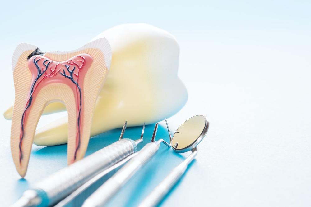 Root Canal Awareness Month: Busting Myths About Root Canals in Coral Gables