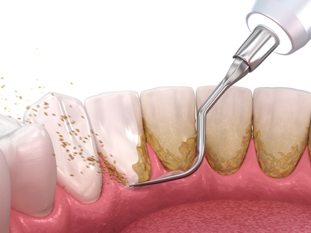 Periodontal-Therapy