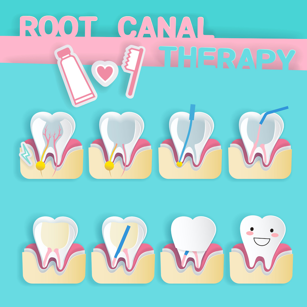 3 Fun Facts in Honor of Root Canal Appreciation Day